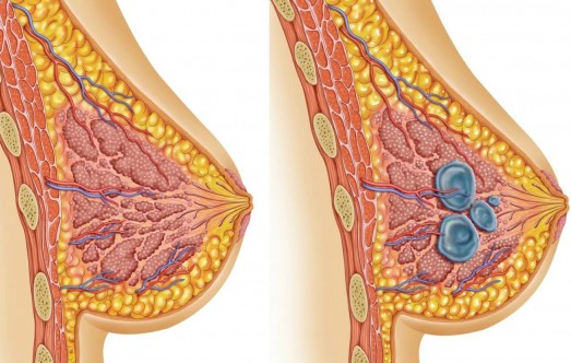 Действительно ли белокочанная капуста помогает в лечении фиброзно-кистозных изменений (мастопатии)?